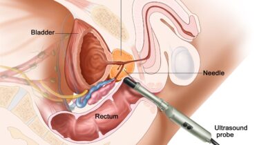 Natural Orifice Transrectal Surgery