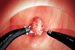 Tumor Removal