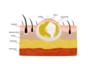 Abscess Drainage