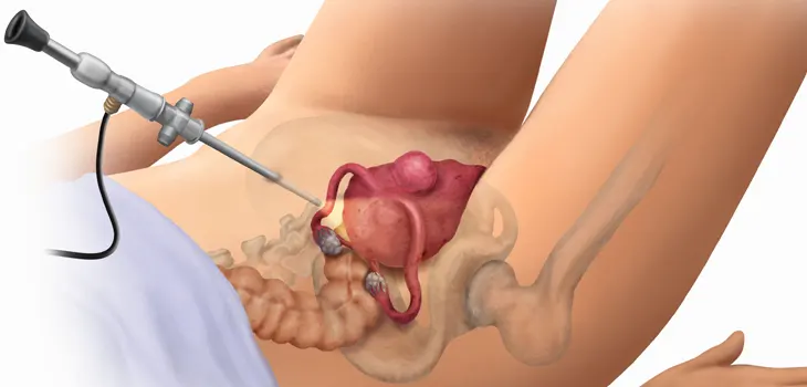 Natural Orifice Transgastric Surgery
