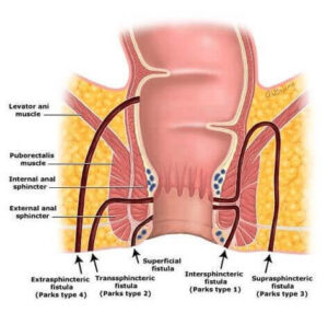 Fistula Repair
