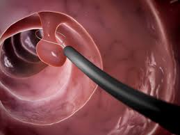 Polyp Removal