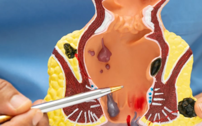 Rectum Treatment